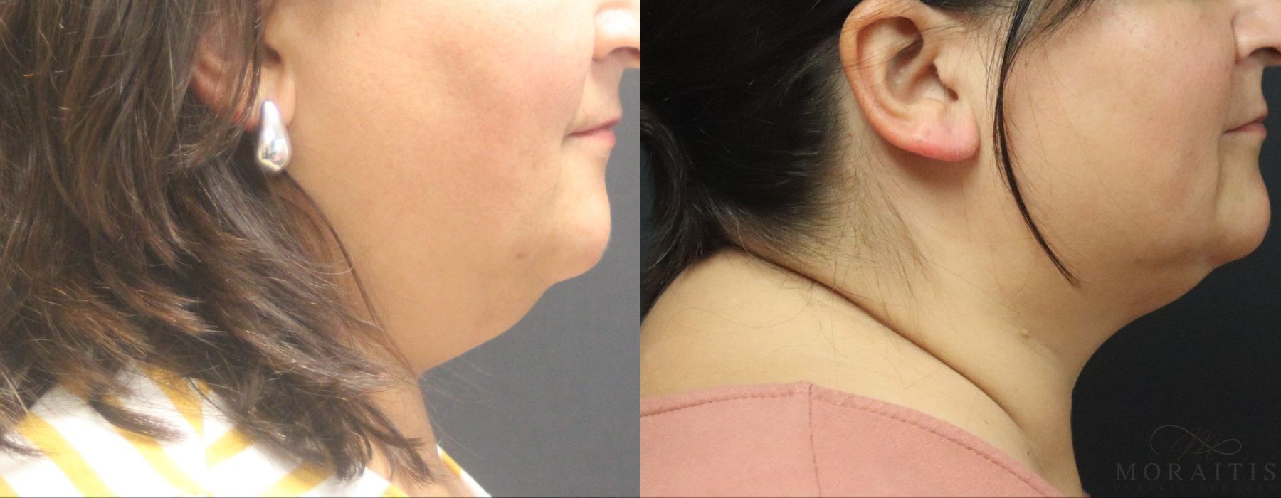 Coolsculpting (non-Surgical Body Contouring) - Case 15306