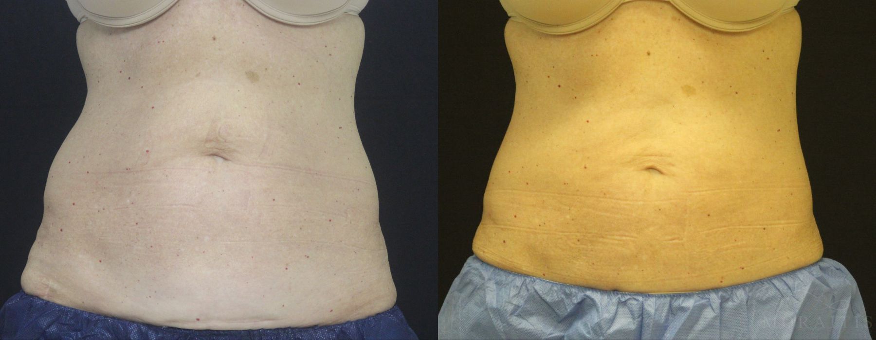 Coolsculpting (non-Surgical Body Contouring) - Case 15330