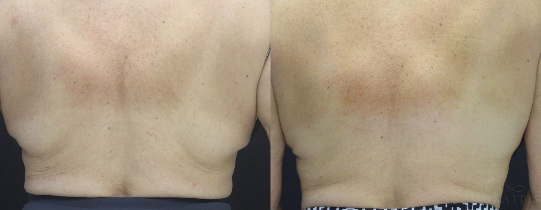 Coolsculpting (non-Surgical Body Contouring) - Case 15303