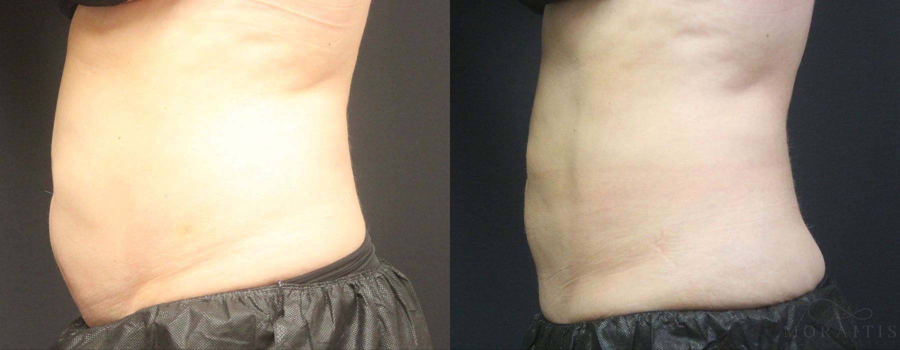 Coolsculpting (non-Surgical Body Contouring) - Thumbnail 2