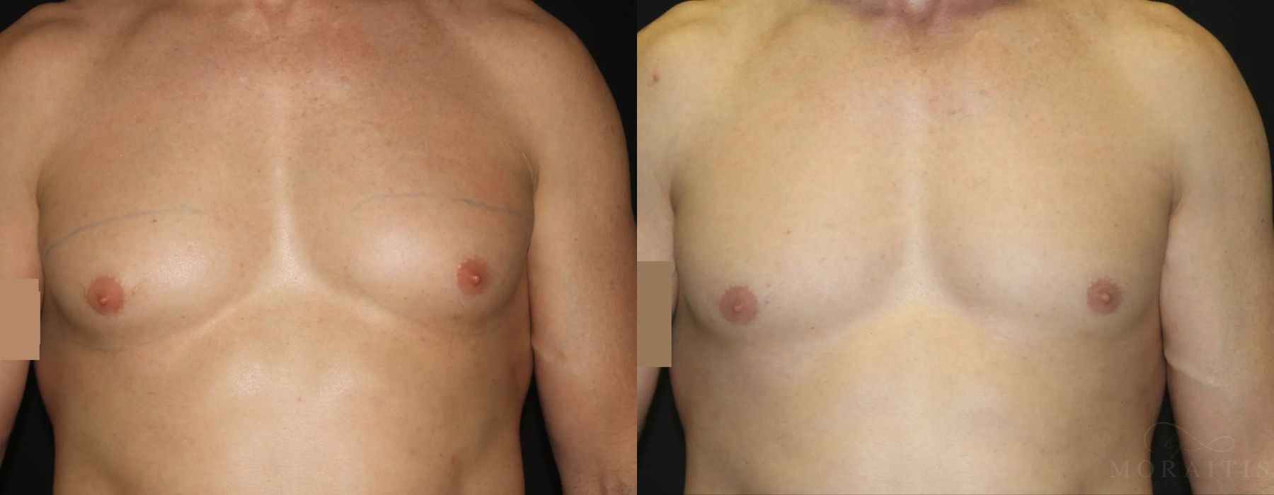 Coolsculpting (non-Surgical Body Contouring) - Case 15314