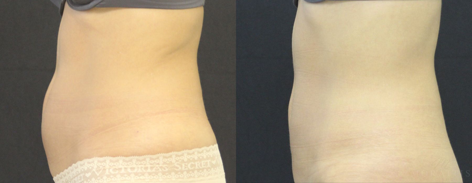 Coolsculpting (non-Surgical Body Contouring) - Thumbnail 3