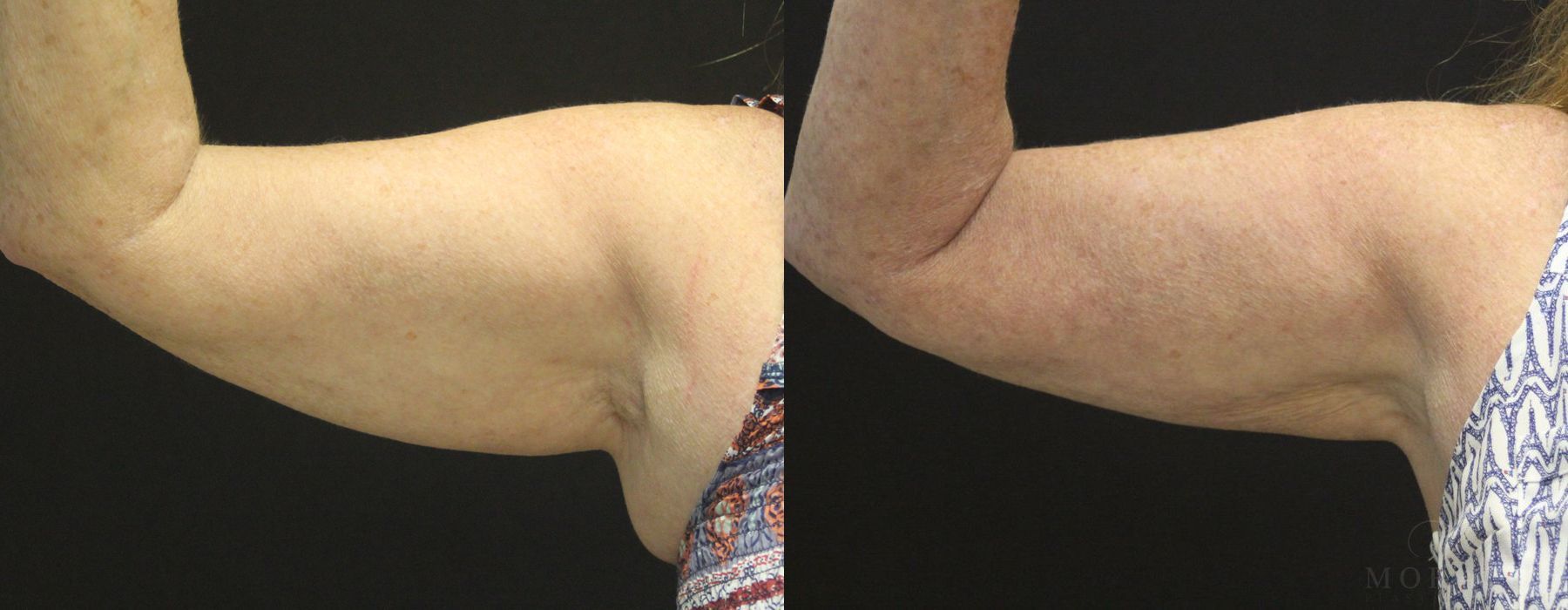 Coolsculpting (non-Surgical Body Contouring) - Case 15318