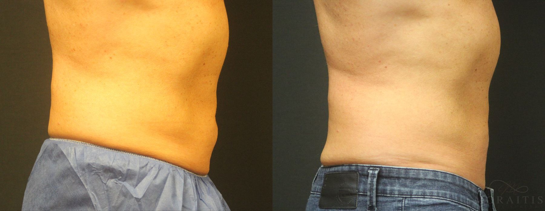 Coolsculpting (non-Surgical Body Contouring) - Thumbnail 2
