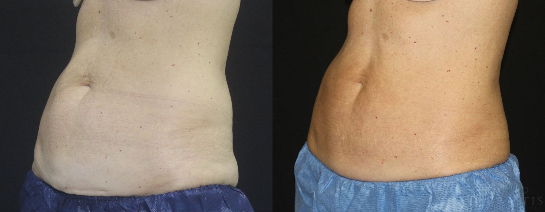 Coolsculpting (non-Surgical Body Contouring) - Thumbnail 2