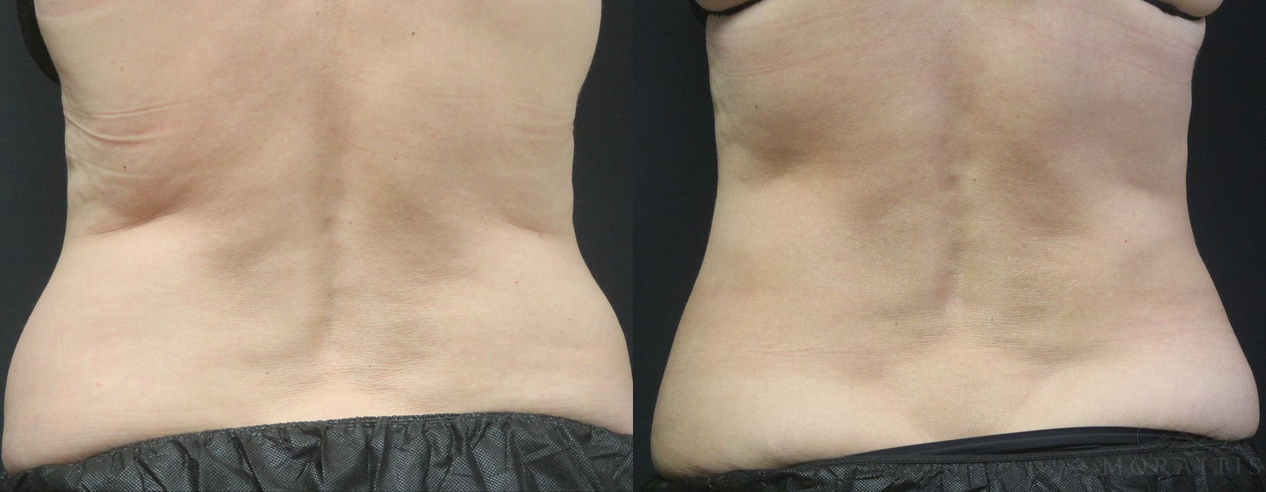 Coolsculpting (non-Surgical Body Contouring) - Thumbnail 3