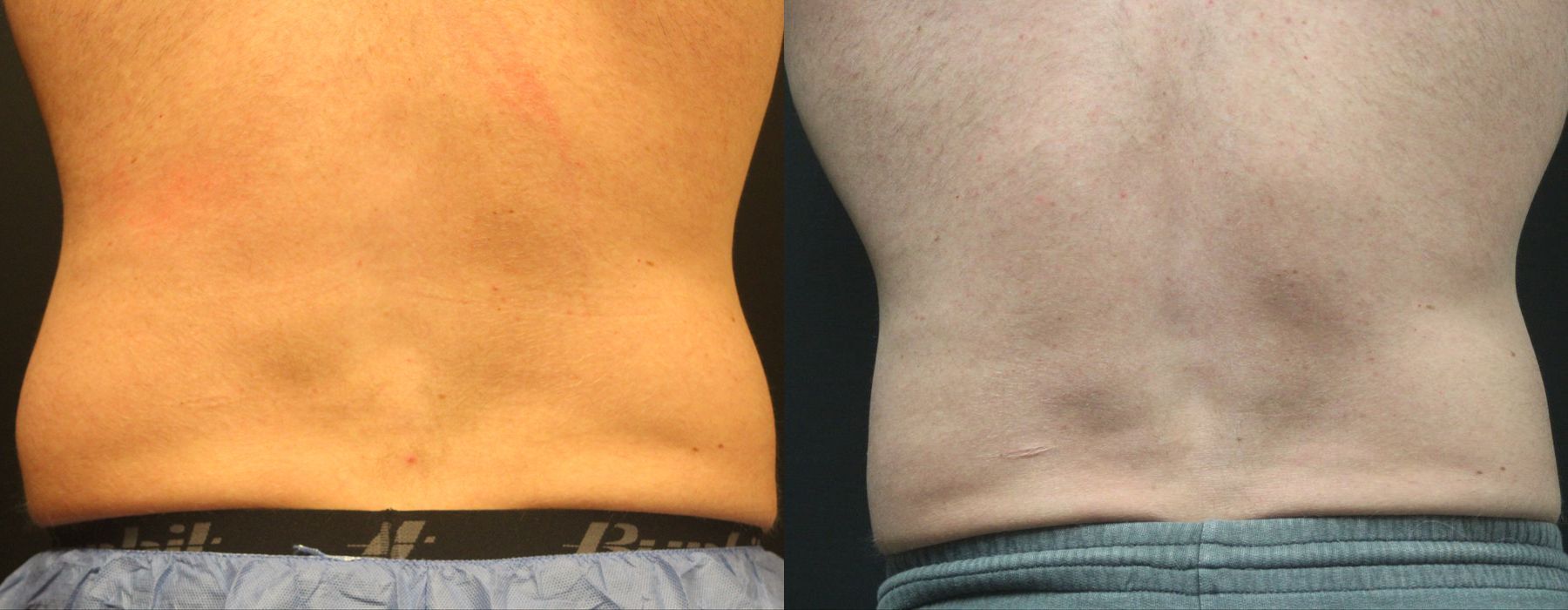 Coolsculpting (non-Surgical Body Contouring) - Case 15313