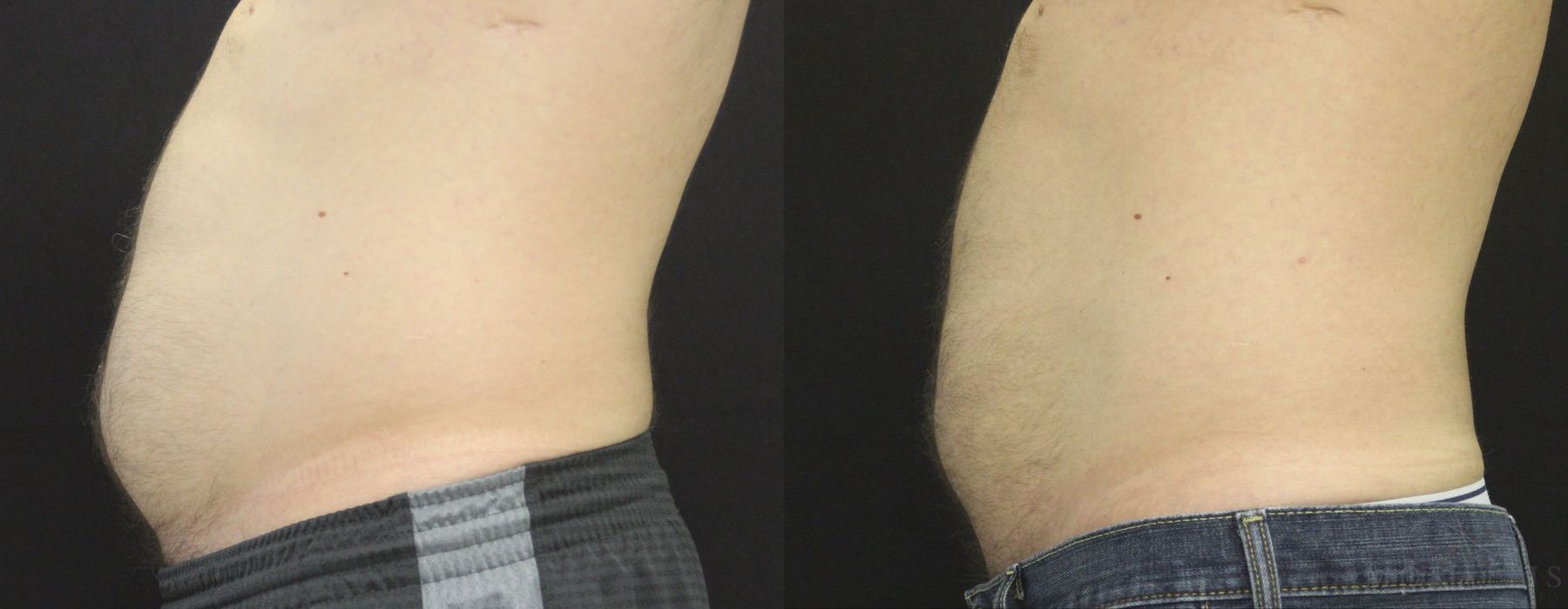 Coolsculpting (non-Surgical Body Contouring) - Thumbnail 2