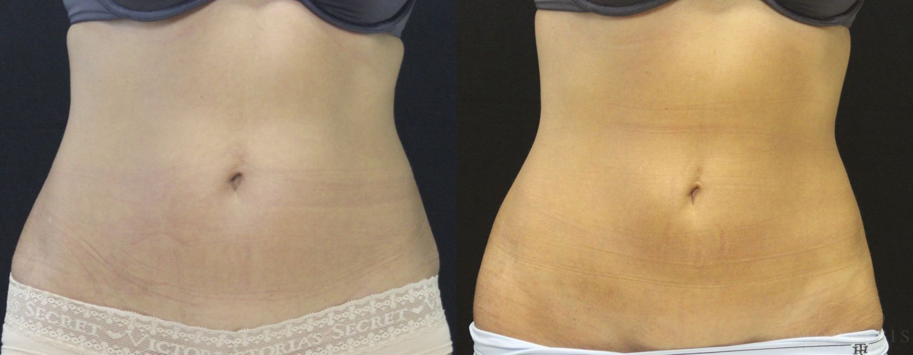 Coolsculpting (non-Surgical Body Contouring) - Case 15324
