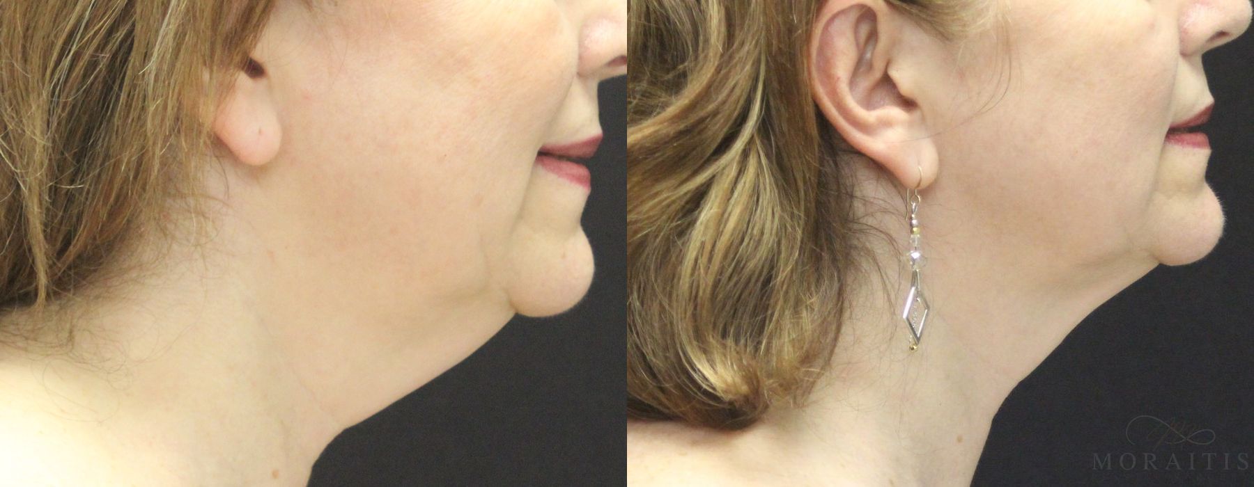 Coolsculpting (Non-Surgical Body Contouring) - Case 19951