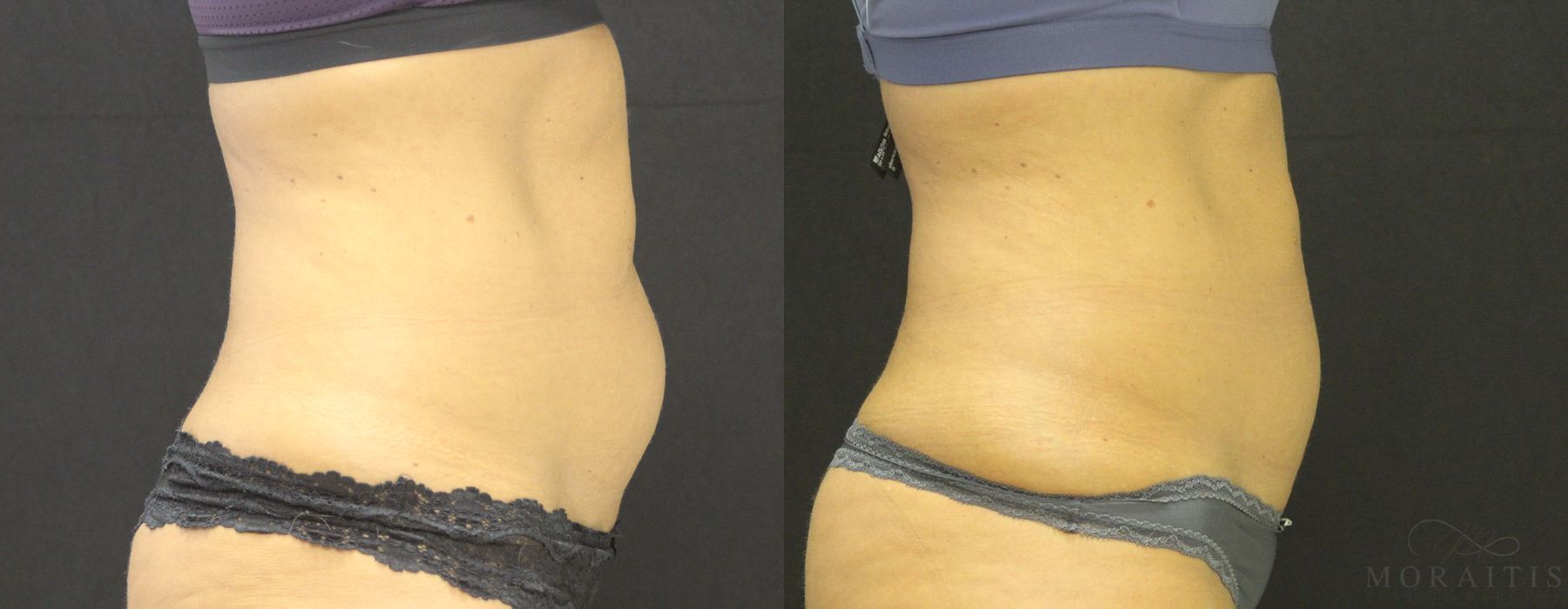Coolsculpting (non-Surgical Body Contouring) - Thumbnail 2