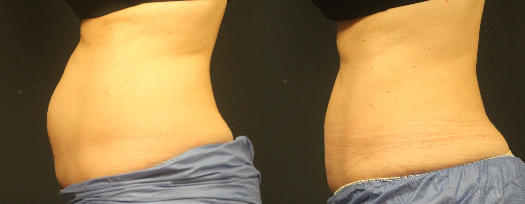 Coolsculpting (non-Surgical Body Contouring) - Thumbnail 3