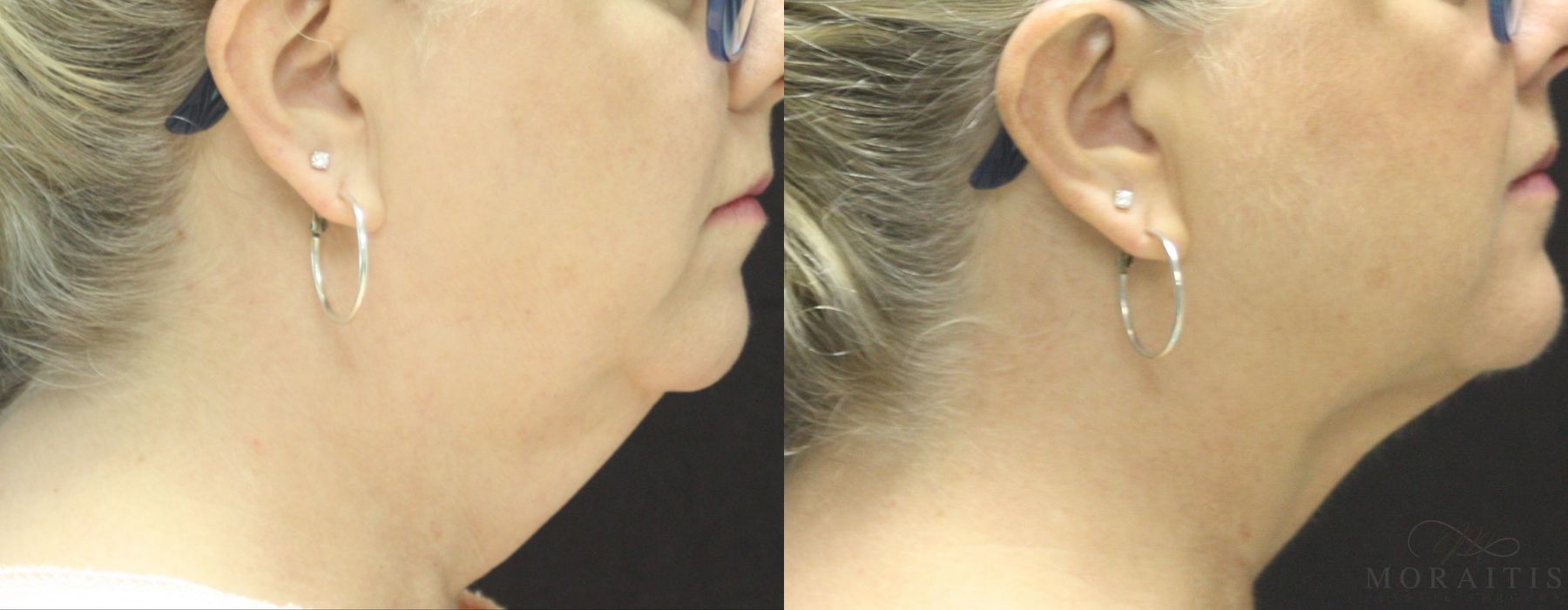 Coolsculpting (non-Surgical Body Contouring) - Case 15309