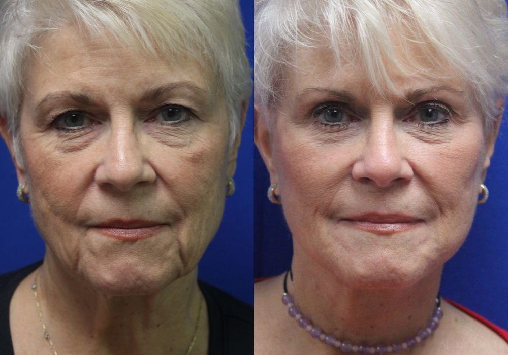 Facelift - Case 15480