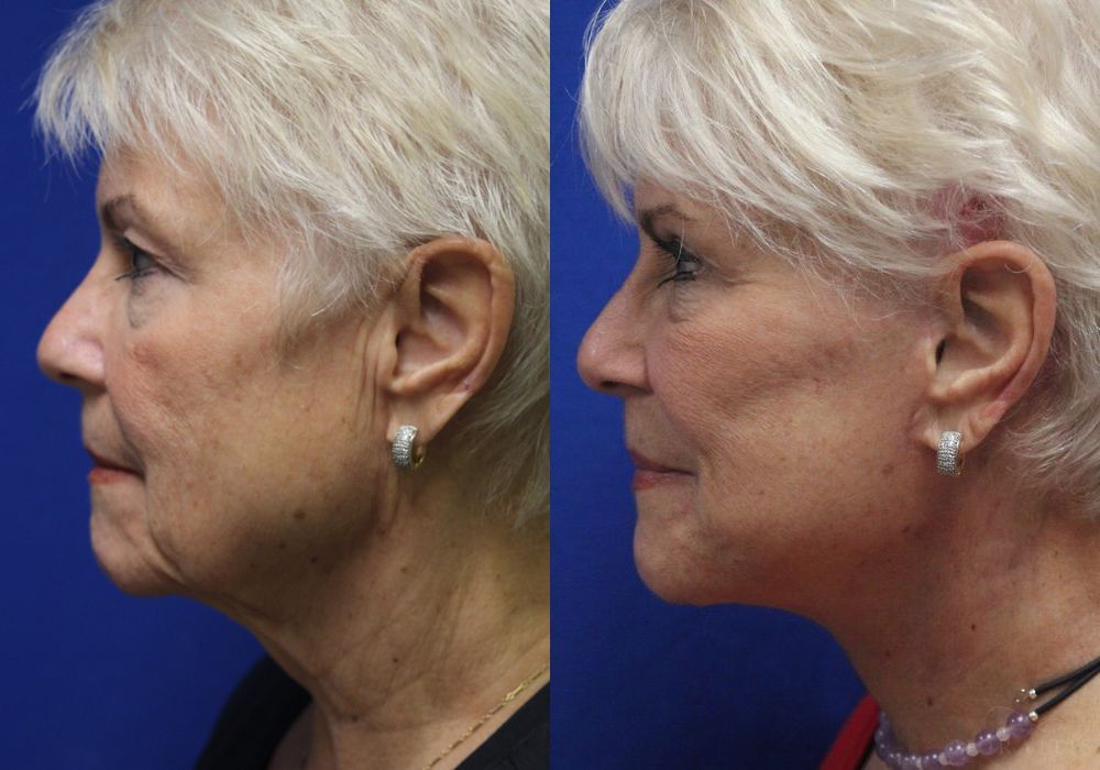 Facelift - Thumbnail 2