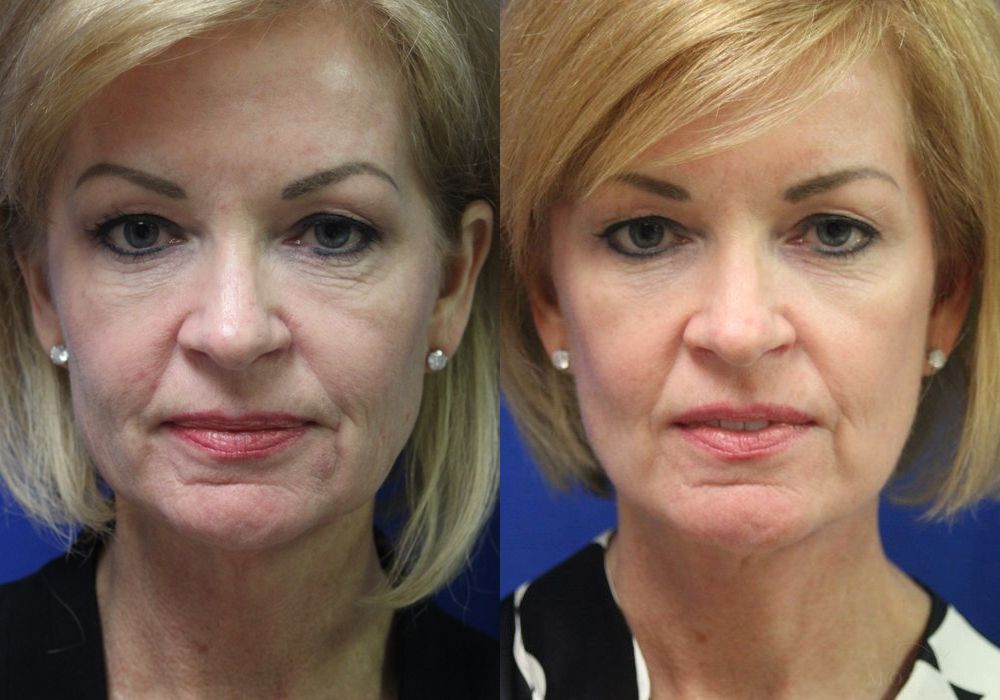 Facelift - Case 15479