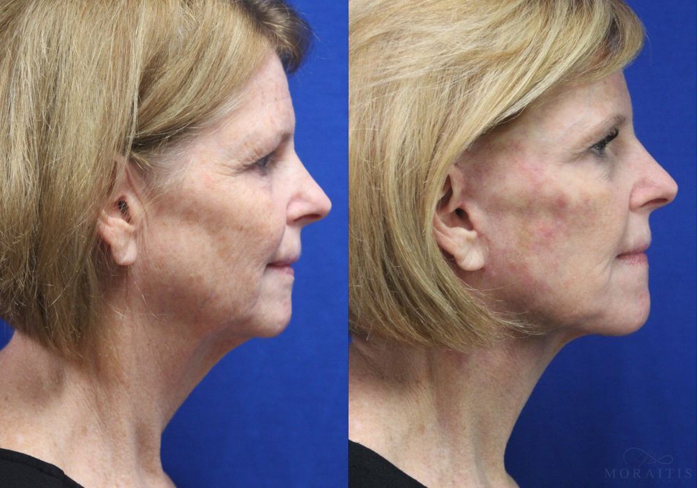 Facelift - Thumbnail 2