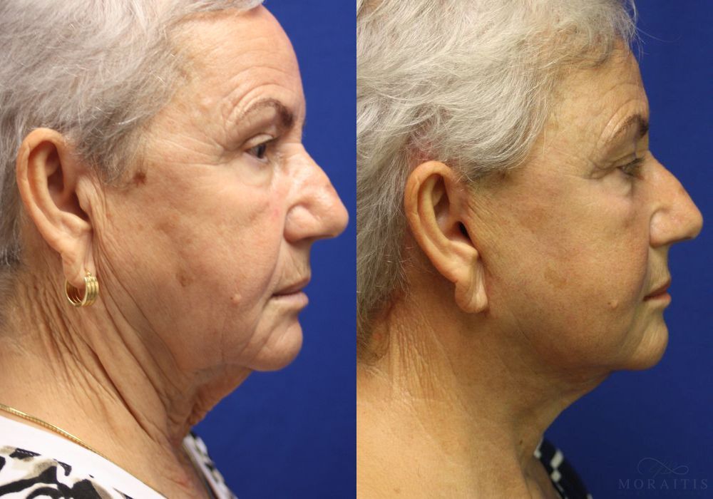 Facelift - Thumbnail 2