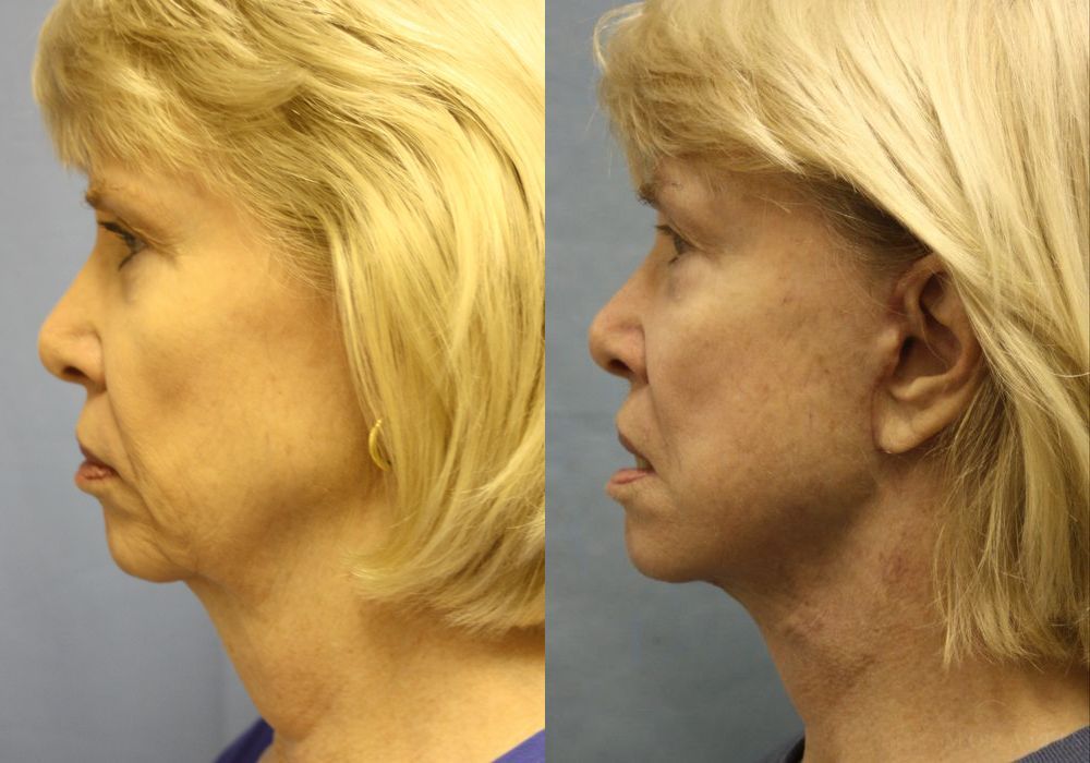Facelift - Thumbnail 2