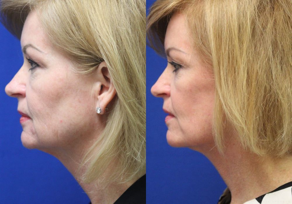 Facelift - Thumbnail 2