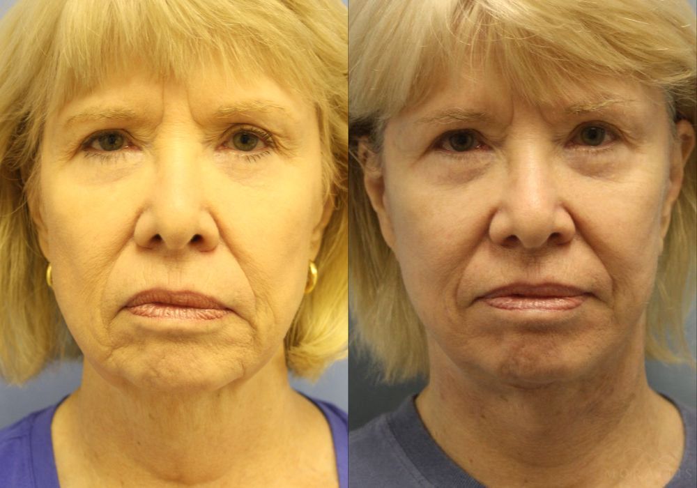 Facelift - Case 15482