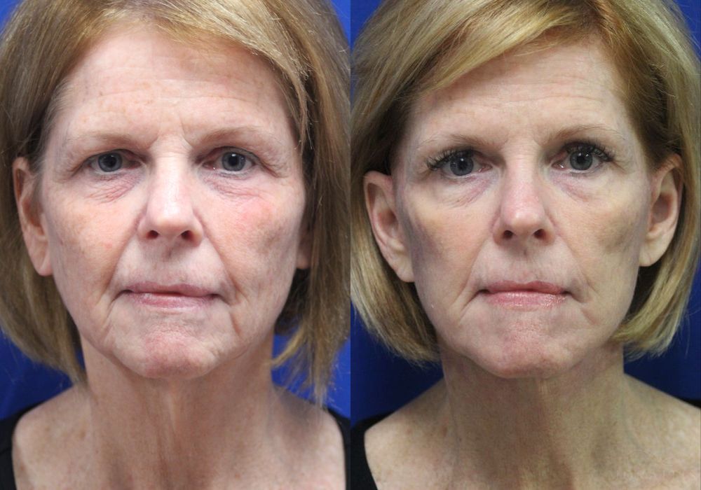 Facelift - Case 15478