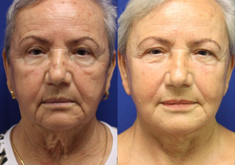 Facelift - Case 15481