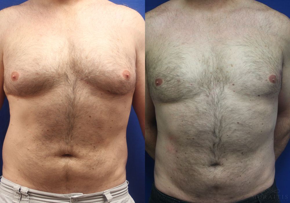 Gynecomastia - Case 15334