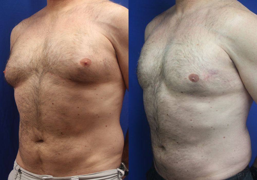 Gynecomastia - Thumbnail 2
