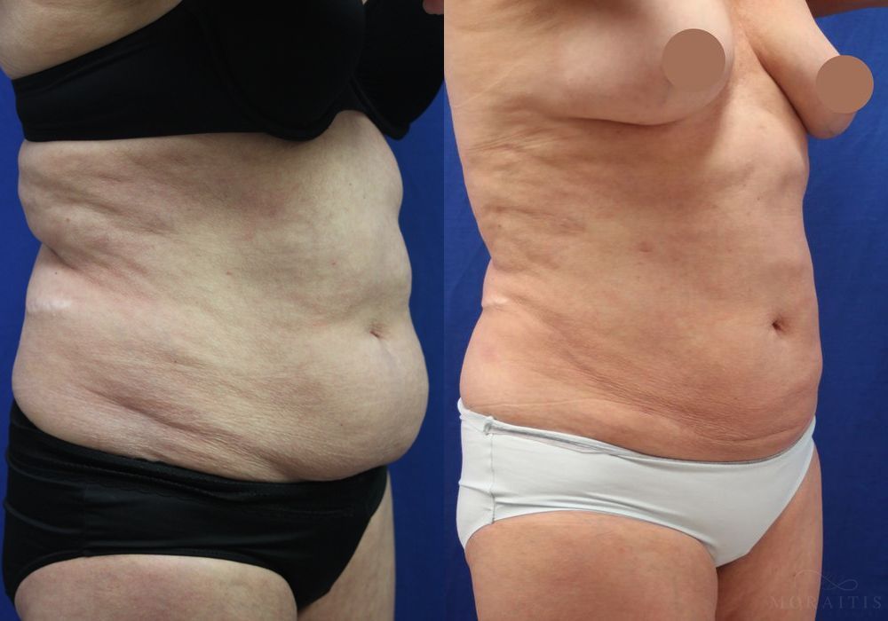 Liposuction - Thumbnail 2