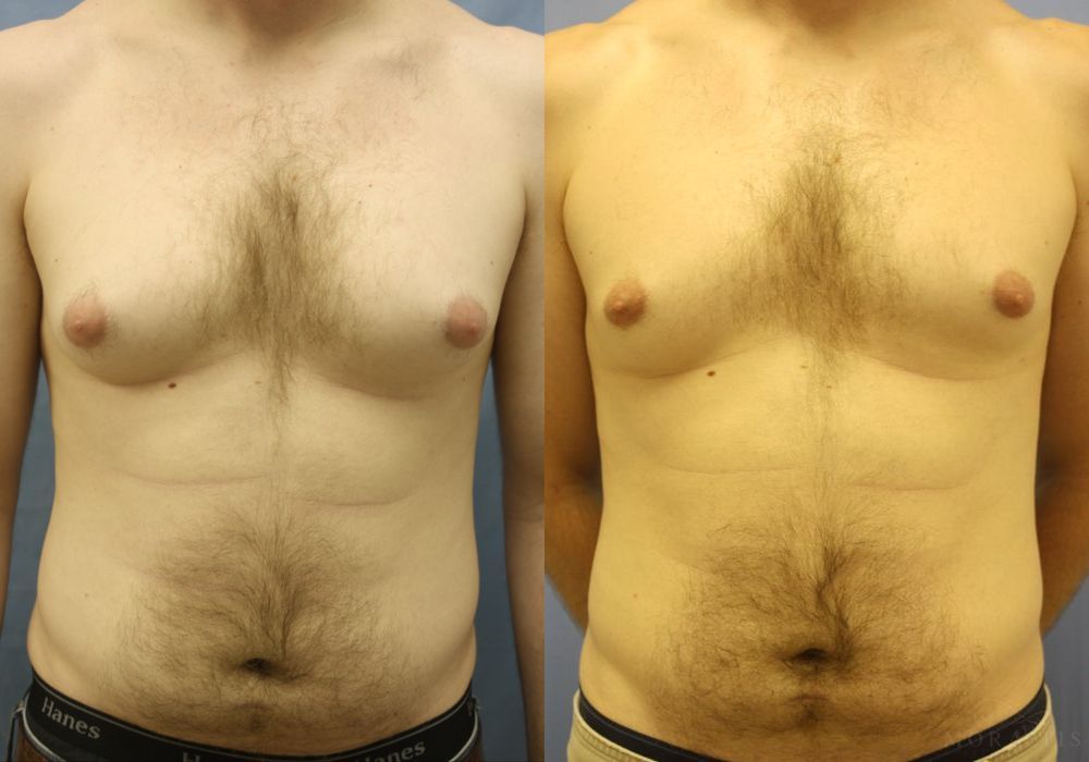 Gynecomastia - Case 15333