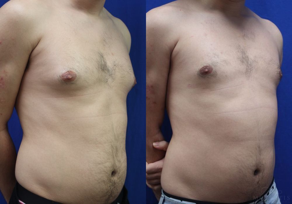 Gynecomastia - Thumbnail 2