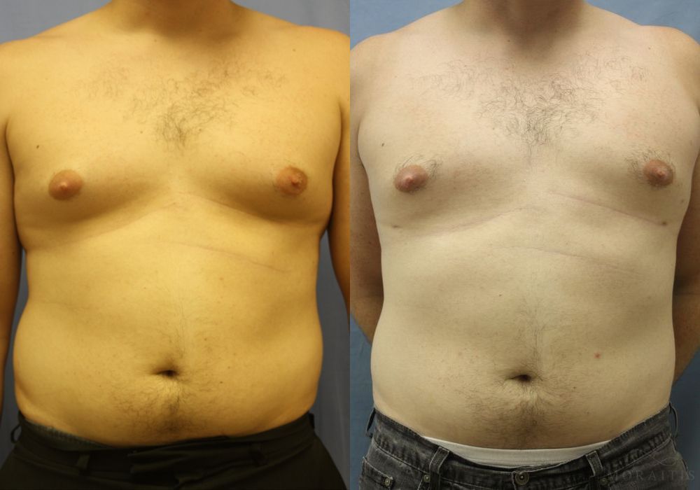 Gynecomastia - Case 15331