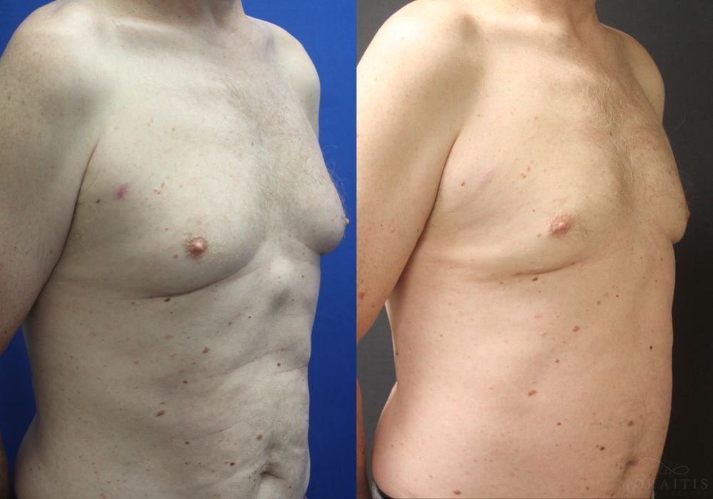 Gynecomastia - Thumbnail 2