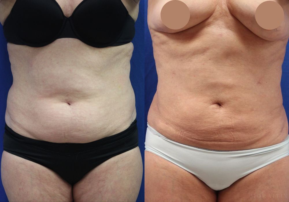 Liposuction - Case 15336