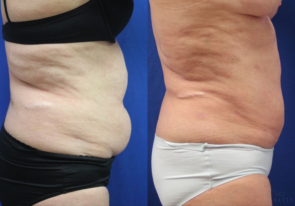 Liposuction - Thumbnail 3