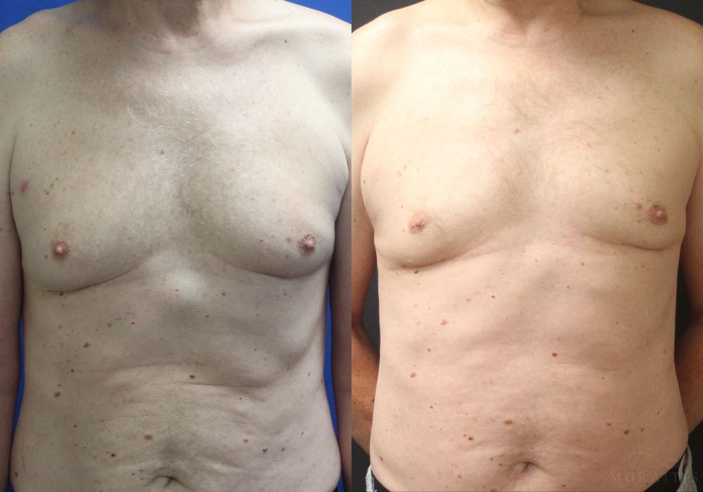 Gynecomastia - Case 15335