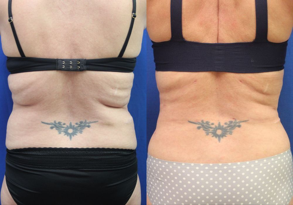 Liposuction - Thumbnail 4