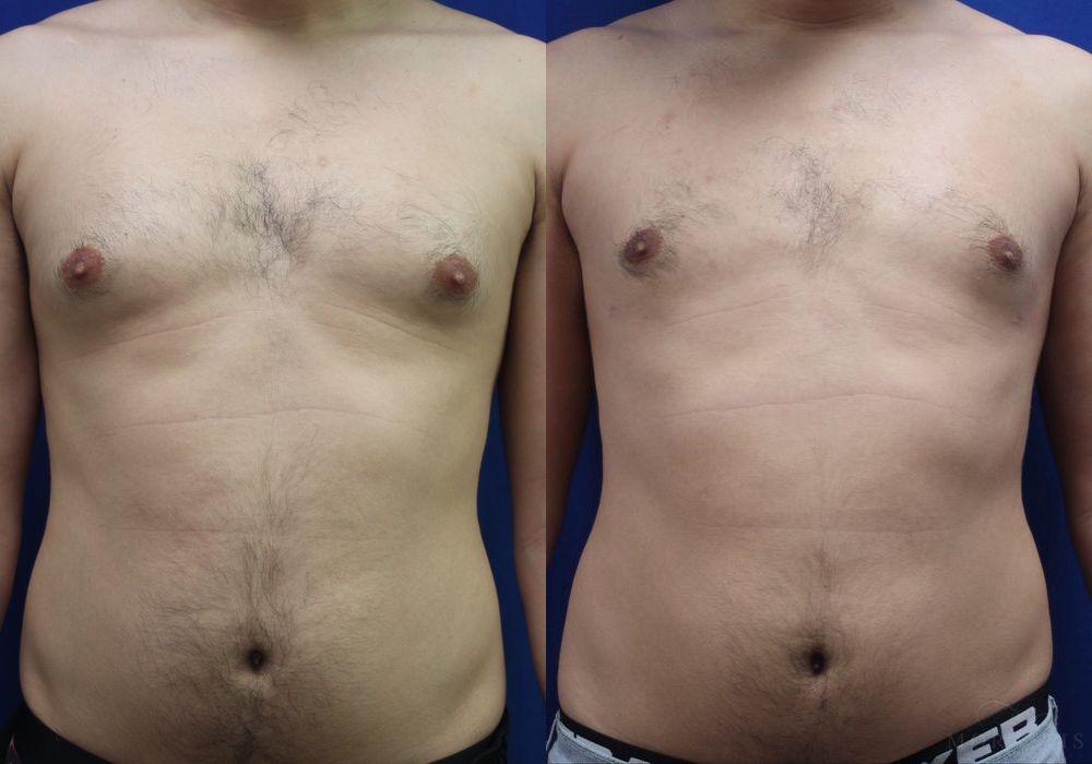 Gynecomastia - Case 15332