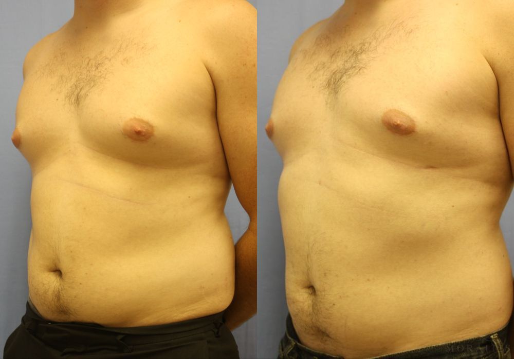 Gynecomastia - Thumbnail 2