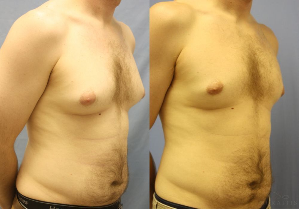 Gynecomastia - Thumbnail 2