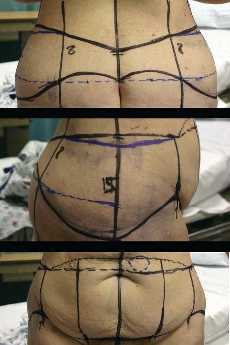 Lower Body Lift - Thumbnail 5