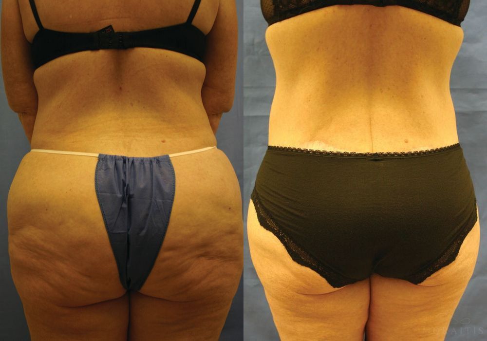Lower Body Lift - Thumbnail 4