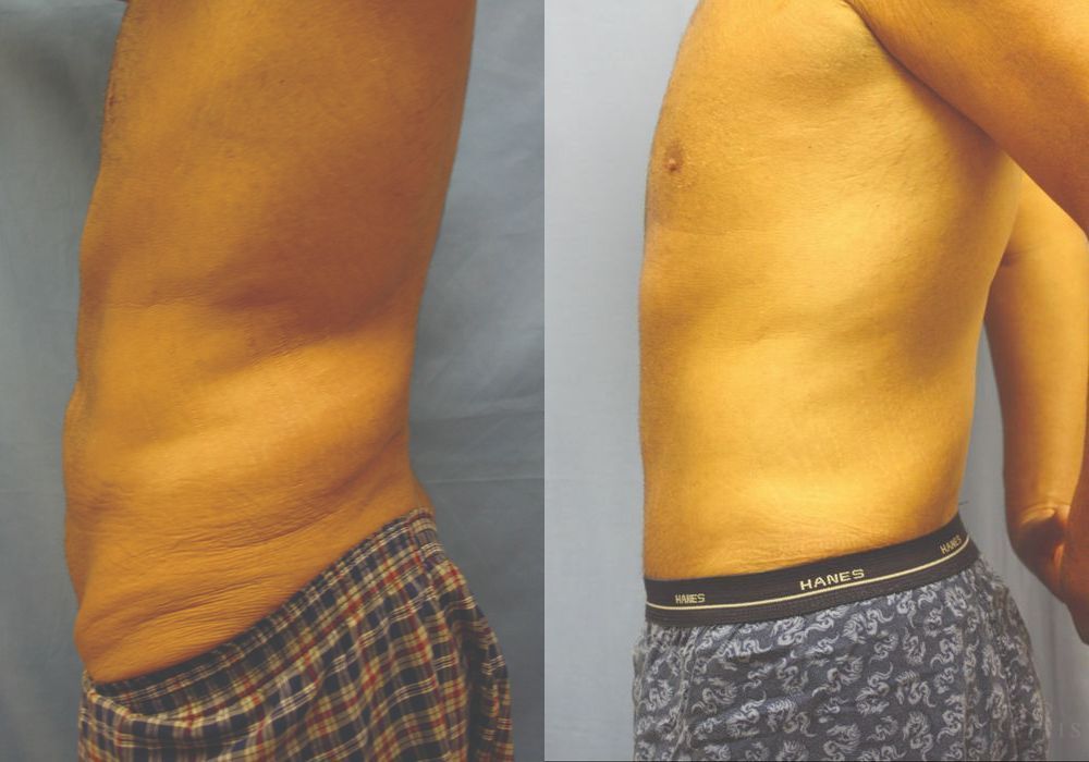 Lower Body Lift - Thumbnail 3