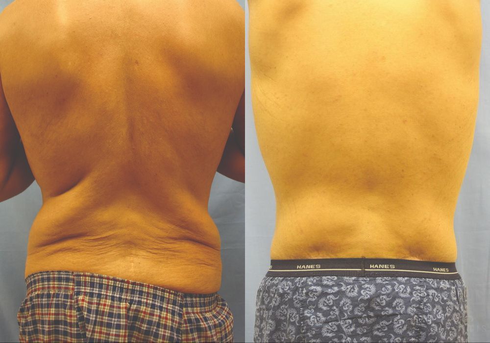 Lower Body Lift - Thumbnail 4