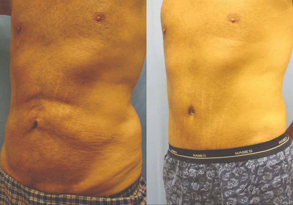 Lower Body Lift - Thumbnail 2