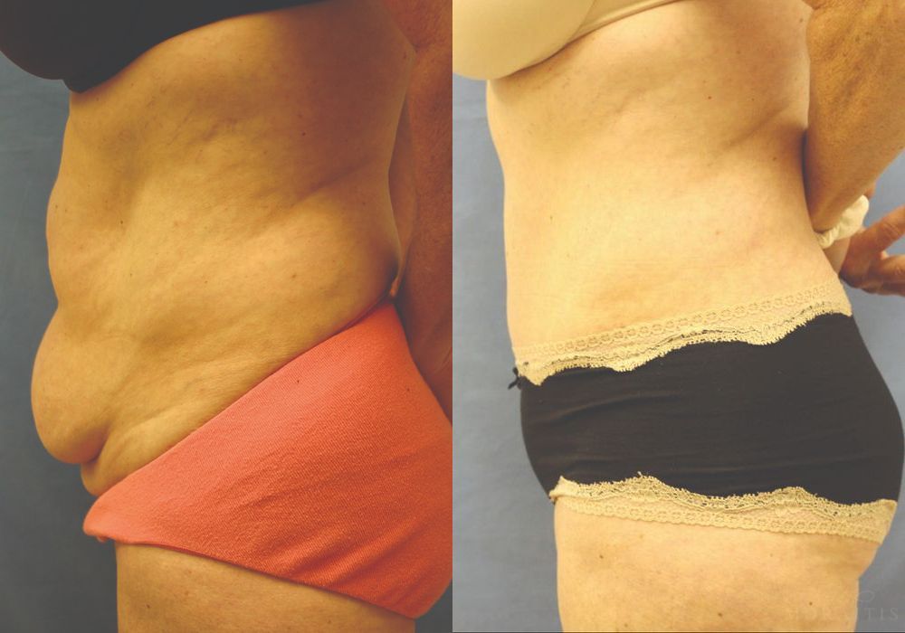 Tummy Tuck - Thumbnail 3