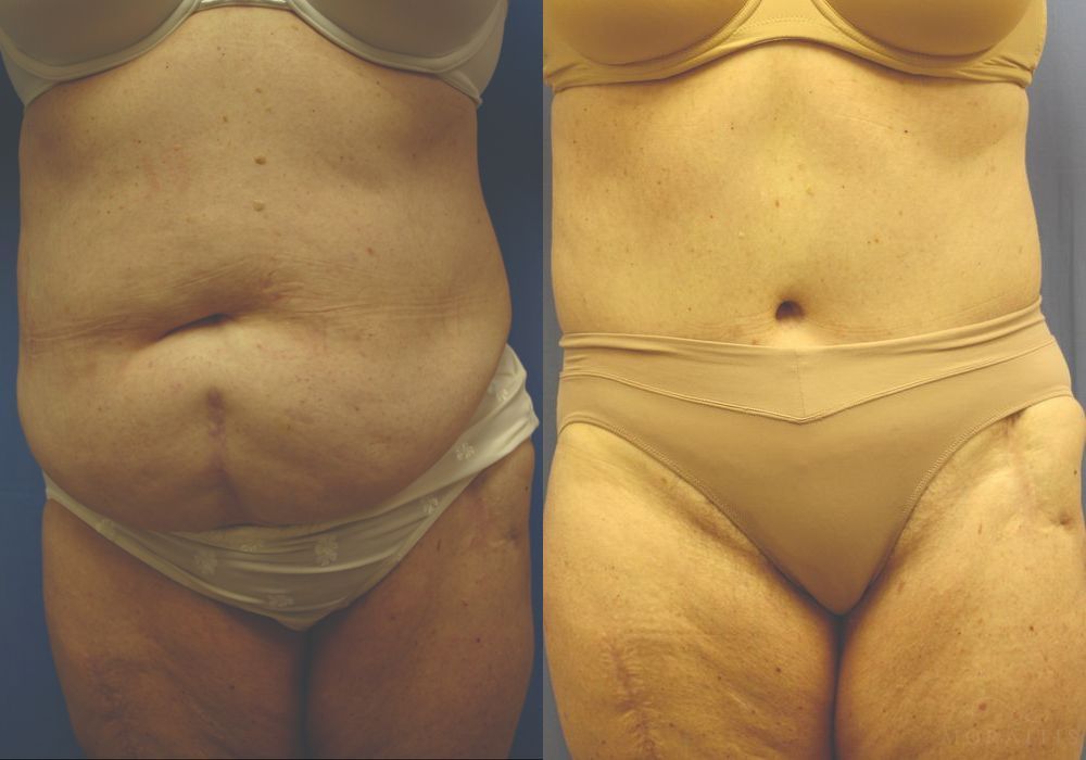 Tummy Tuck - Case 15360