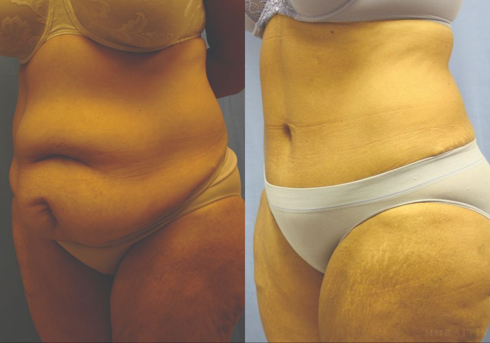 Tummy Tuck - Thumbnail 2