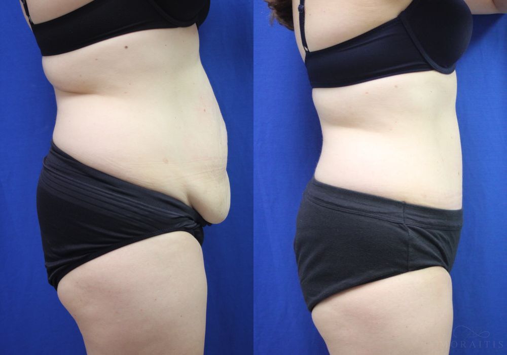 Tummy Tuck - Thumbnail 2